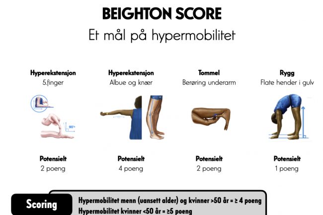 Beighton Score er et uttrykk for generalisert hypermobilitet 